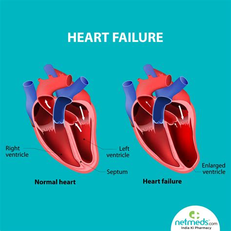 lvf medical abbreviation|what is mild lv dysfunction.